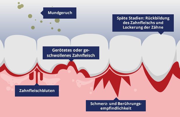 Zahnfleischentzündung