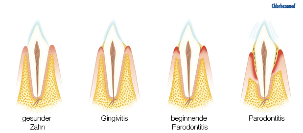 Zahnfleischerkrankungen