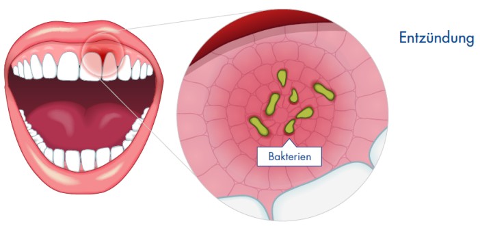 mund_entzuendung